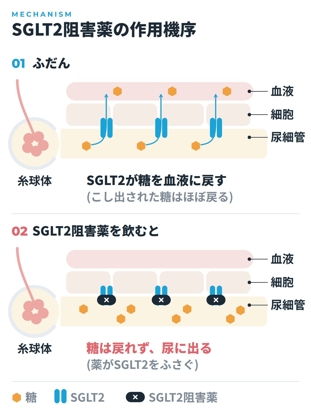 ふだんは尿細管の細胞にあるSGLT2が、糸球体でこし出された糖を血液に戻す。SGLT2阻害薬がSGLT2をふさぐと、糖は血液に戻れず尿に出る、を上下で比べた図